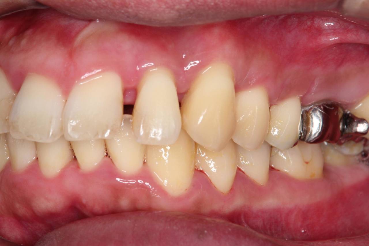 外科処置後3ヶ月の歯茎(メインテナンス処置)<br>外科処置の3月後ですが、歯茎の状態はより改善し、歯周ポケットも3mm以内となりました。