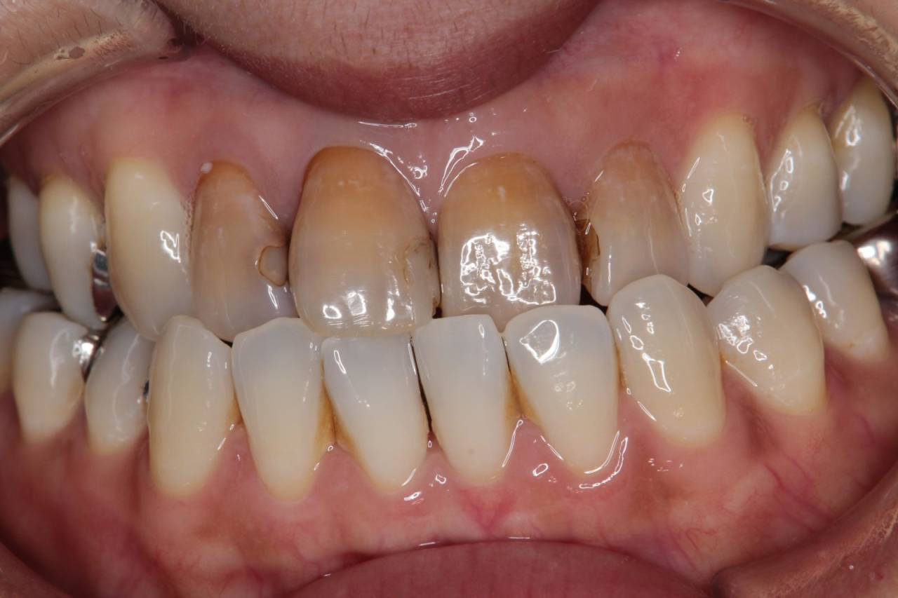 初診時の写真<br>前歯の色、歯並びを気にされ来院されました。