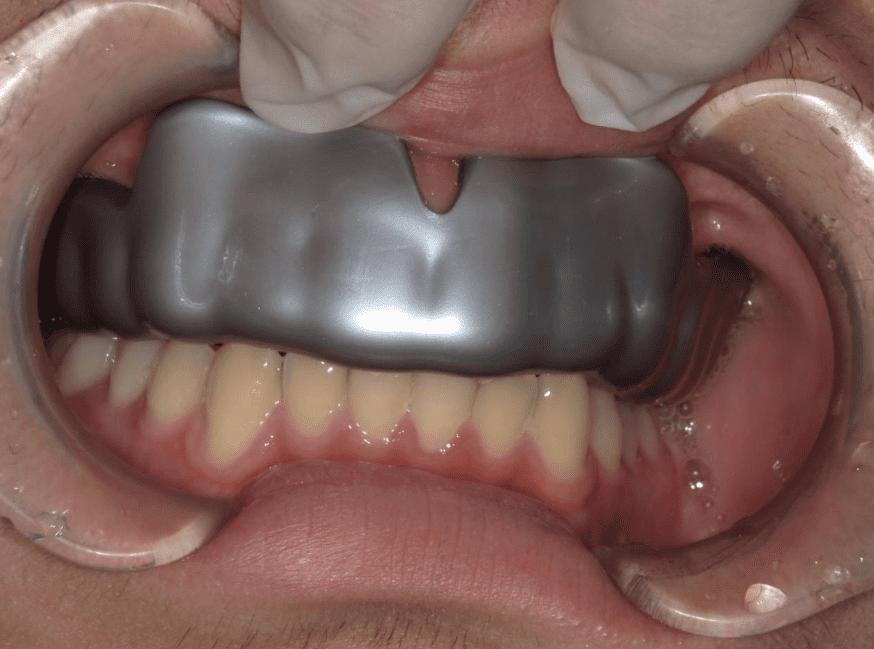 スポーツ用マウスピース