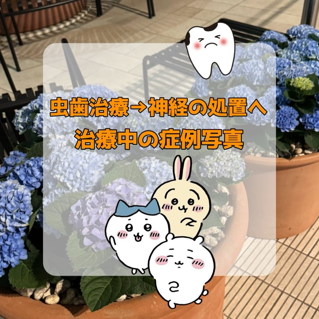 虫歯治療→神経の処置(抜髄)へ移行した方の症例写真をお見せし...